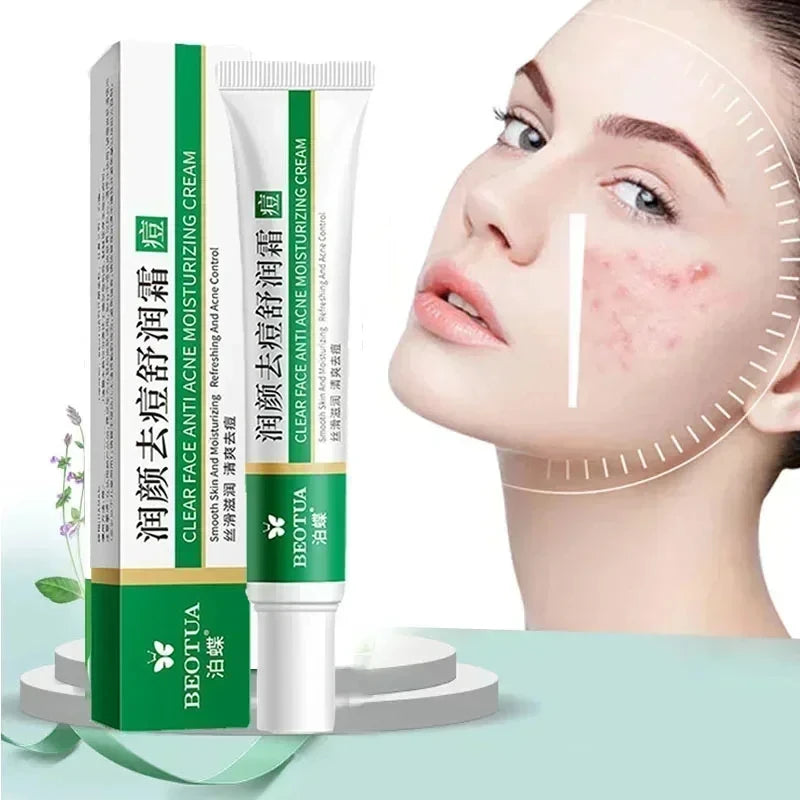 Herbal Acne Treatment Cream — Scar Repair, Blackhead Remover & Pore Minimiser